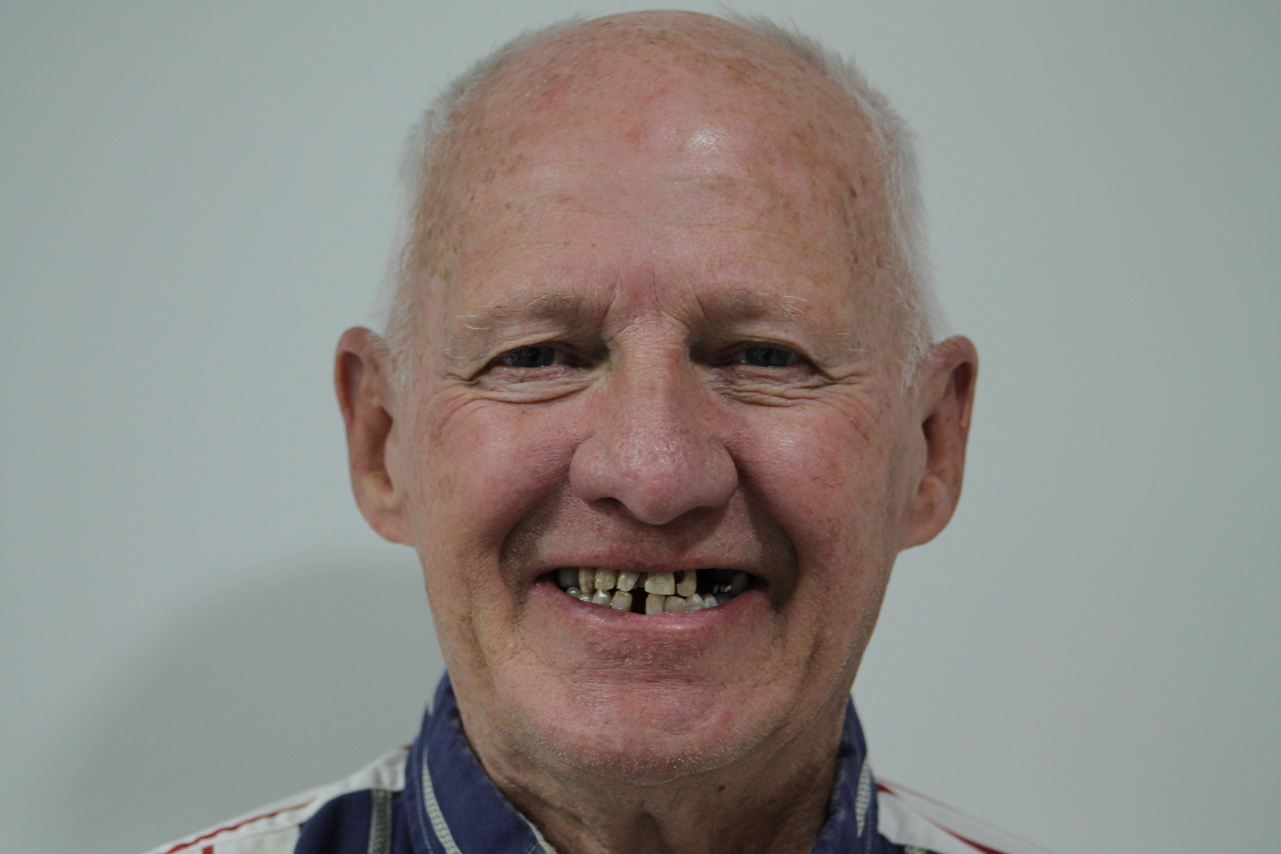 Antes del tratamiento